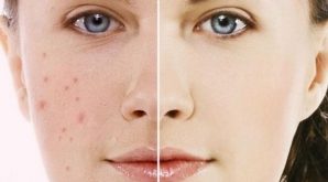 Top 10 Cách trị thâm mụn hiệu quả tại nhà nhanh nhất