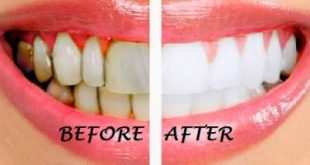 Top 13 Cách làm đẹp răng tự nhiên, trắng sáng hiệu quả nhất