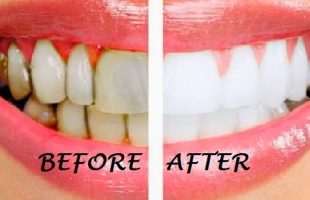 Top 13 Cách làm đẹp răng tự nhiên, trắng sáng hiệu quả nhất