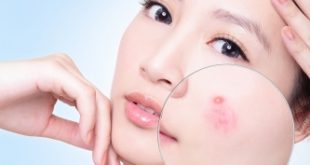 Top 5 Spa trị mụn hiệu quả nhất thành phố Vinh, Nghệ An