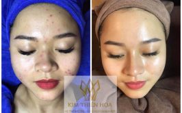 Top 6 Spa trị mụn hiệu quả nhất ở Nha Trang