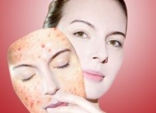 Top 7 Spa trị mụn hiệu quả nhất Quy Nhơn, Bình Định