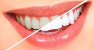 Top 9 Cách làm trắng răng hiệu quả nhất tại nhà với Baking soda